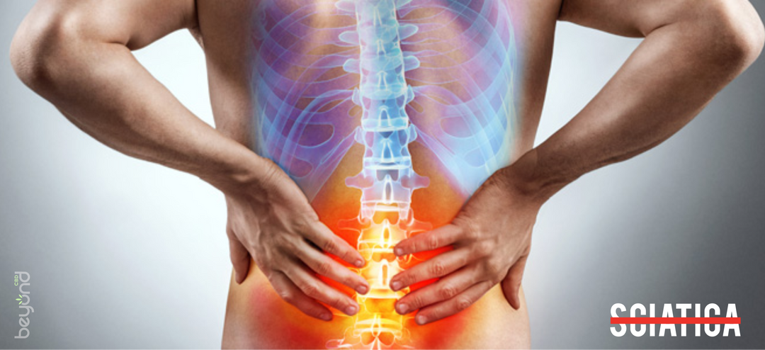 CBD vs. Sciatica